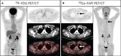 Comparison of [68Ga]Ga-DOTA-FAPI-04 and [18F]FDG Uptake in Esophageal Cancer